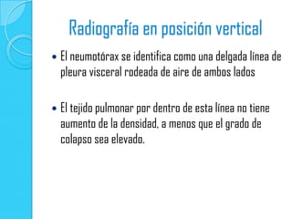 Radiografía en posición vertical
   El neumotórax se identifica como una delgada línea de
    pleura visceral rodeada de aire de ambos lados

   El tejido pulmonar por dentro de esta línea no tiene
    aumento de la densidad, a menos que el grado de
    colapso sea elevado.
 