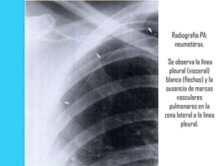 Radiografía PA:
    neumotórax.

  Se observa la línea
  pleural (visceral)
 blanca (flechas) y la
 ausencia de marcas
     vasculares
  pulmonares en la
zona lateral a la línea
       pleural.
 
