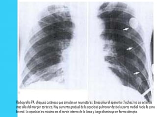 Radiografía PA: pliegues cutáneos que simulan un neumotórax. Línea pleural aparente (flechas) no se extiende
mas allá del margen torácico. Hay aumento gradual de la opacidad pulmonar desde la parte medial hacia la zona
lateral. La opacidad es máxima en el borde interno de la línea y luego disminuye en forma abrupta.
 