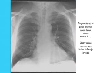 Pliegue cutáneo en
  pared torácica
   izquierda que
       simula
    neumotórax.

  Obsérvese que
  sobrepasa los
límites de la caja
     torácica
 