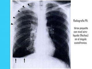 Radiografía PA:

  tórax pequeño
 con nivel aire-
liquido (flechas)
   en el ángulo
  costofrenico.
 