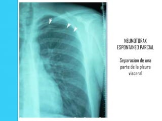 NEUMOTORAX
ESPONTANEO PARCIAL

 Separacion de una
 parte de la pleura
      visceral
 