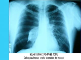 NEUMOTORAX ESPONTANEO TOTAL
Colapso pulmonar total y formación del muñón
 