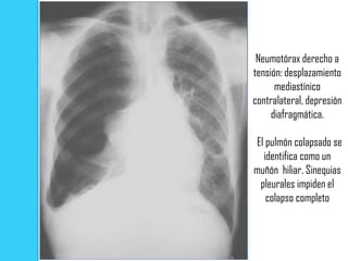 Neumotórax derecho a
tensión: desplazamiento
      mediastínico
contralateral, depresión
     diafragmática.

El pulmón colapsado se
  identifica como un
muñón hiliar. Sinequias
 pleurales impiden el
   colapso completo
 