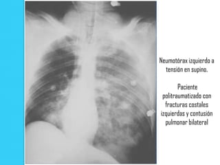 Neumotórax izquierdo a
  tensión en supino.

        Paciente
 politraumatizado con
  fracturas costales
izquierdas y contusión
  pulmonar bilateral
 