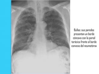 Bullas: sus paredes
  presentan un borde
 cóncavo con la pared
torácica frente al borde
convexo del neumotórax
 