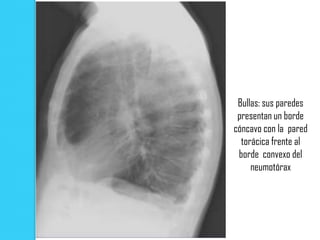 Bullas: sus paredes
 presentan un borde
cóncavo con la pared
  torácica frente al
 borde convexo del
     neumotórax
 