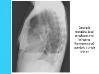 Cámara de
  neumotórax basal
  derecho con nivel
     hidroaéreo
 (hidroneumotórax)
secundario a cirugía
      torácica
 