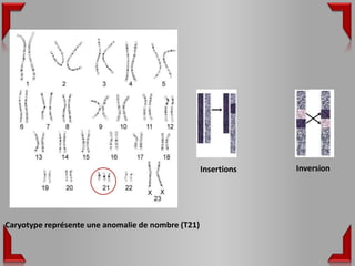 Insertions   Inversion




Caryotype représente une anomalie de nombre (T21)
 