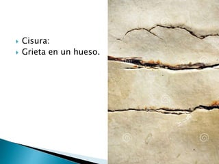  Cisura:
 Grieta en un hueso.
 
