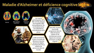 La MA est la forme
la plus courante de
démence chez les
personnes âgées,
touchant plus de 35
millions de
personnes dans le
monde
Dans AD, la perte
neuronale
progressive dans le
lobe temporal
médian et de
nombreuses autres
régions du cerveau
provoque un déclin
cognitif.
Les signes
pathologiques de la
MA sont les plaques
β-amyloïdes (Aβ)
extracellulaires, les
enchevêtrements
neurofibrillaires
intracellulaires et la
gliose
 
