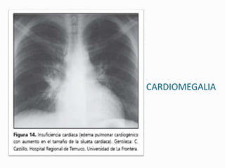 CARDIOMEGALIA
 