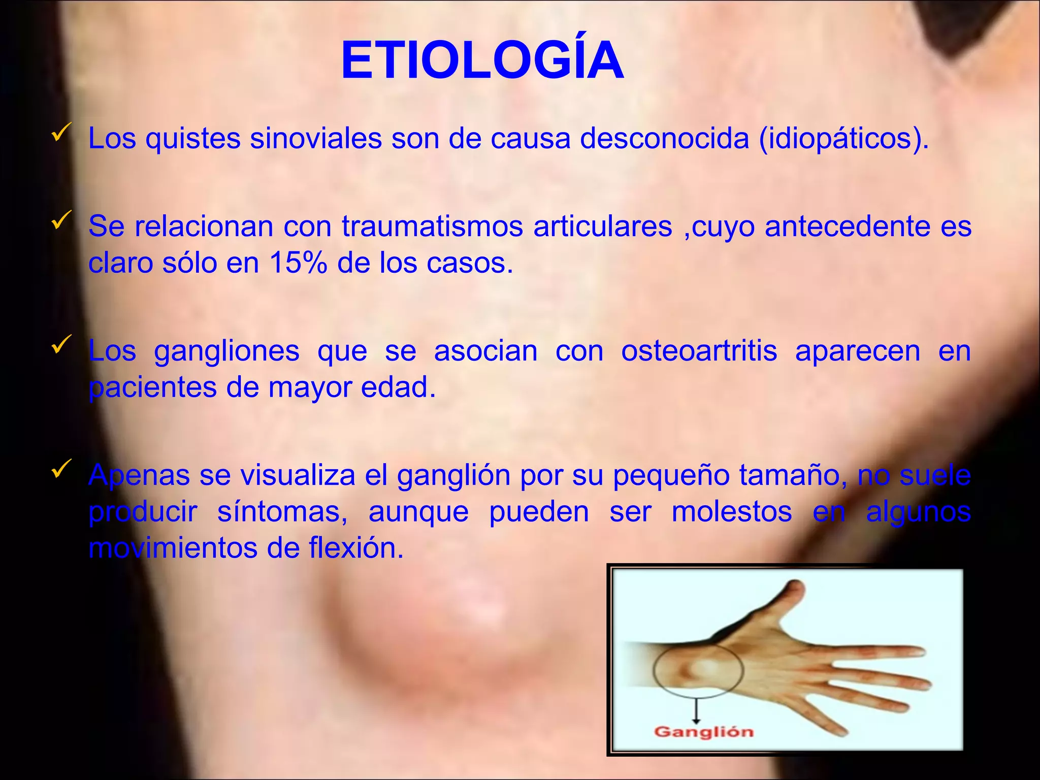 Expocicion del ganglión en la muñeca | PPT