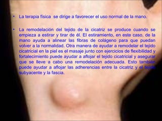 Expocicion del ganglión en la muñeca | PPT