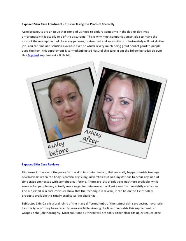 Exposed Skin Care Treatment Tips For Using The Product Correctly