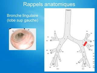 Rappels anatomiques
Bronche lingulaire
(lobe sup gauche)
 
