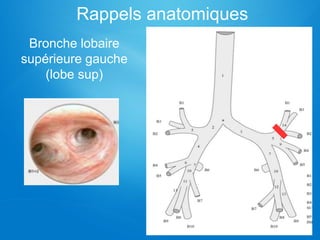 Rappels anatomiques
Bronche lobaire
supérieure gauche
(lobe sup)
 