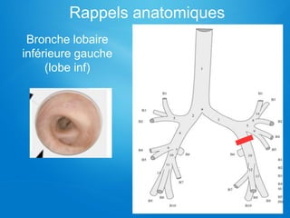 Rappels anatomiques
Bronche lobaire
inférieure gauche
(lobe inf)
 