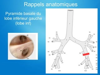 Rappels anatomiques
Pyramide basale du
lobe inférieur gauche
(lobe inf)
 