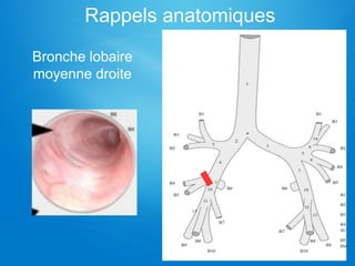 Rappels anatomiques
Bronche lobaire
moyenne droite
 