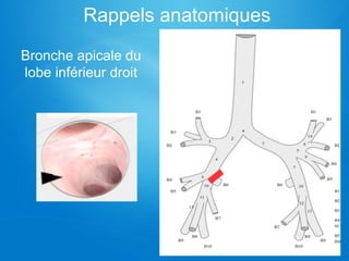 Rappels anatomiques
Bronche apicale du
lobe inférieur droit
 
