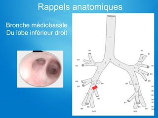 Rappels anatomiques
Bronche médiobasale
Du lobe inférieur droit
 