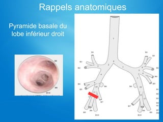Rappels anatomiques
Pyramide basale du
lobe inférieur droit
 