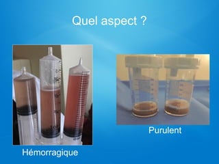 Quel aspect ?
Purulent
Hémorragique
 