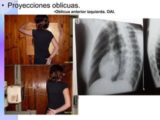 • Proyecciones oblicuas.
•Oblicua anterior izquierda. OAI.