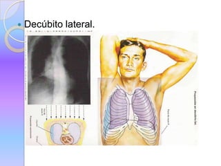  Decúbito lateral.