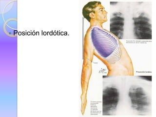  Posición lordótica.