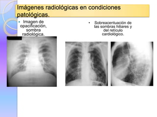 Imágenes radiológicas en condiciones
patológicas.
Imagen de • Sobreacentuación de
opacificación, las sombras hiliares y
sombra del retículo
radiológica. cardiológico.