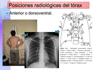 Posiciones radiológicas del tórax
Anterior o dorsoventral.