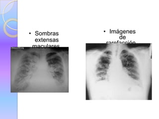 • Sombras • Imágenes
extensas de
rarefacción .
maculares.