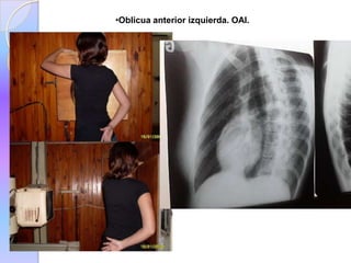 •Oblicua anterior izquierda. OAI.