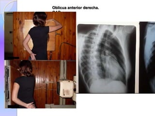 Oblicua anterior derecha.
OAD.