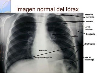 Imagen normal del tórax