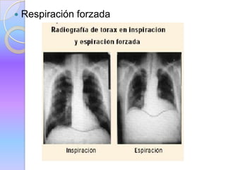  Respiración forzada