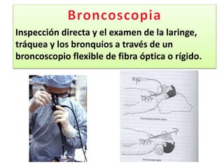 Inspección directa y el examen de la laringe,
tráquea y los bronquios a través de un
broncoscopio flexible de fibra óptica o rígido.
 