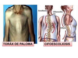 TORÁX DE PALOMA CIFOESCOLIOSIS
 