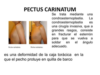 PECTUS CARINATUM
es una deformidad de la caja toràcica en la
que el pecho protuye en quilla de barco
Se trata mediante una
condroesternoplastia. La
condroesternoplastia es
una cirugía invasiva, que a
grandes rasgos, consiste
en fracturar el esternòn
para que se vuelva a
soldar en el ángulo
adecuado.
 