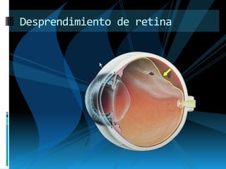 Desprendimiento de retina
 