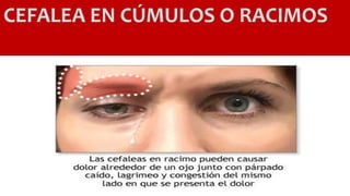 CEFALEA EN CÚMULOS O RACIMOS
 