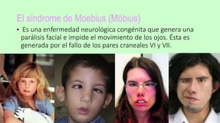 El síndrome de Moebius (Möbius)
• Es una enfermedad neurológica congénita que genera una
parálisis facial e impide el movimiento de los ojos. Ésta es
generada por el fallo de los pares craneales VI y VII.
 