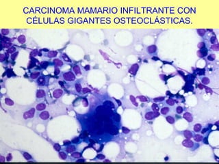 CARCINOMA MAMARIO INFILTRANTE CON CÉLULAS GIGANTES OSTEOCLÁSTICAS. 