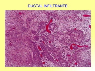 DUCTAL INFILTRANTE 