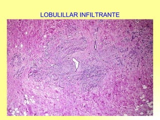 LOBULILLAR INFILTRANTE 