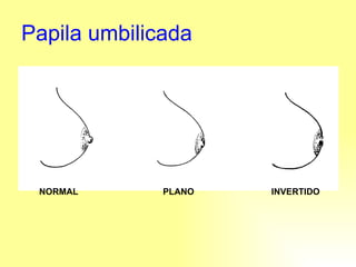 Papila umbilicada NORMAL  PLANO  INVERTIDO 