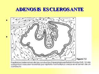 ADENOSIS ESCLEROSANTE Existe fibrosis intralobulillar notable y proliferación de conductillos pequeños y acinos, pero sin atipia de éstos Se caracteriza por: Proliferación de las células de revestimiento epitelial y mioepitelial, glándulas agregadas. Crecimiento excesivo de tejido fibroso, pudiendo comprimir completamente la luz de los acinos y conductos 