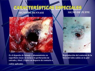 SIGNO DE BENNASI                               SIGNO DE PUPPE




Es el deposito de tatuaje y ahumamiento en           Reproducción del contorno de la
superficies óseas en torno a la perforación de       boca del tubo cañón en la piel
entrada y bisel. (Típico en disparos de contacto o
cañón aplicado)
 